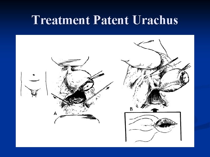 Treatment Patent Urachus 