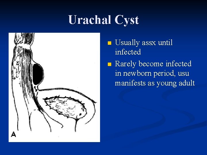 Urachal Cyst n n Usually assx until infected Rarely become infected in newborn period,