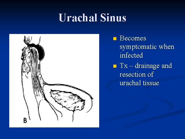 Urachal Sinus n n Becomes symptomatic when infected Tx – drainage and resection of