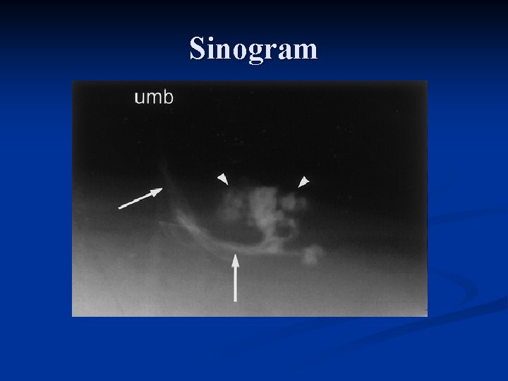 Sinogram 