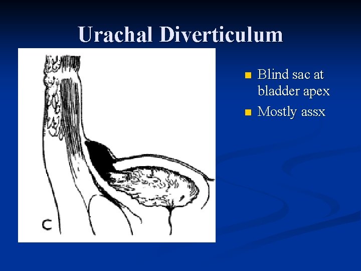 Urachal Diverticulum n n Blind sac at bladder apex Mostly assx 
