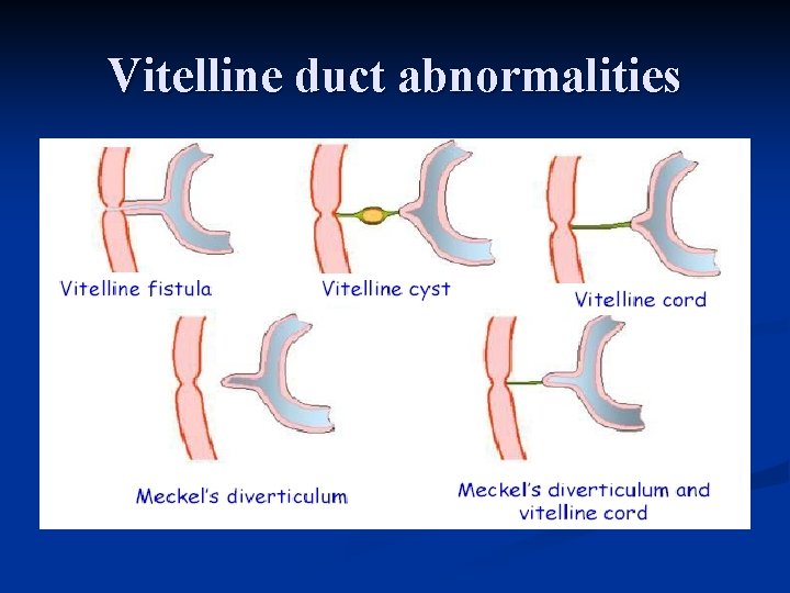 Vitelline duct abnormalities 