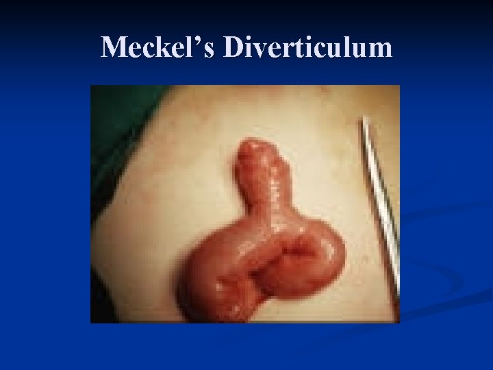Meckel’s Diverticulum 