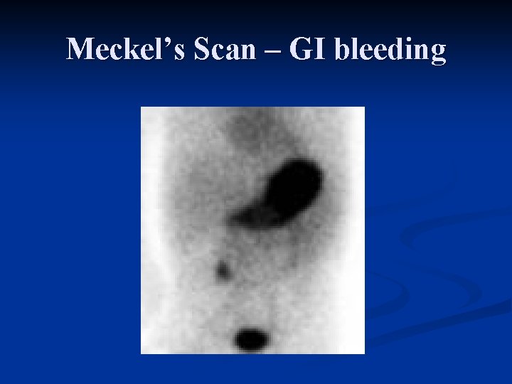 Meckel’s Scan – GI bleeding 