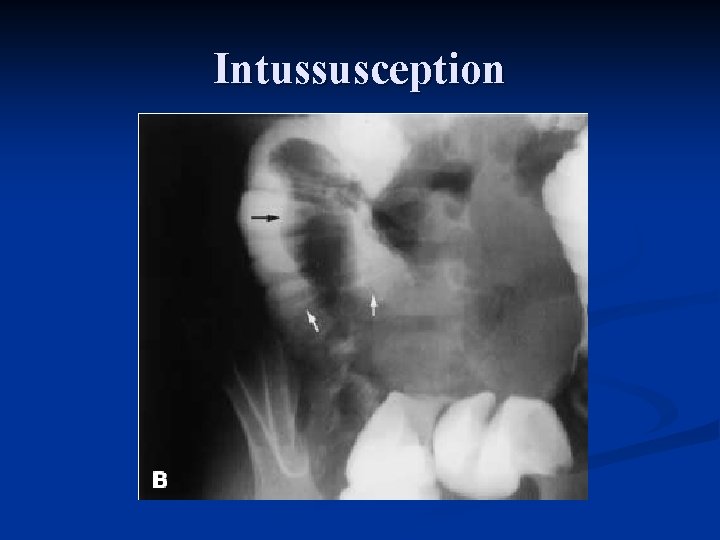 Intussusception 