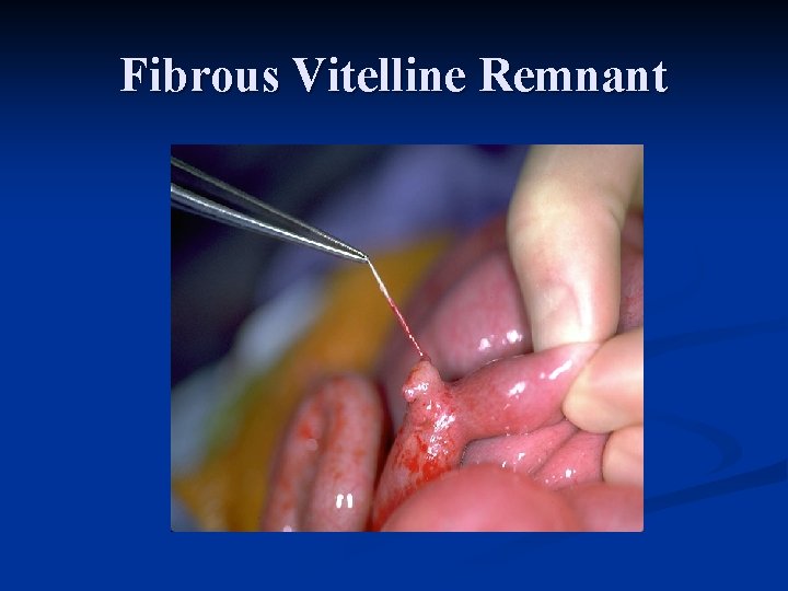 Fibrous Vitelline Remnant 