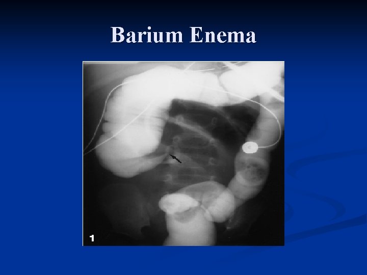 Barium Enema 