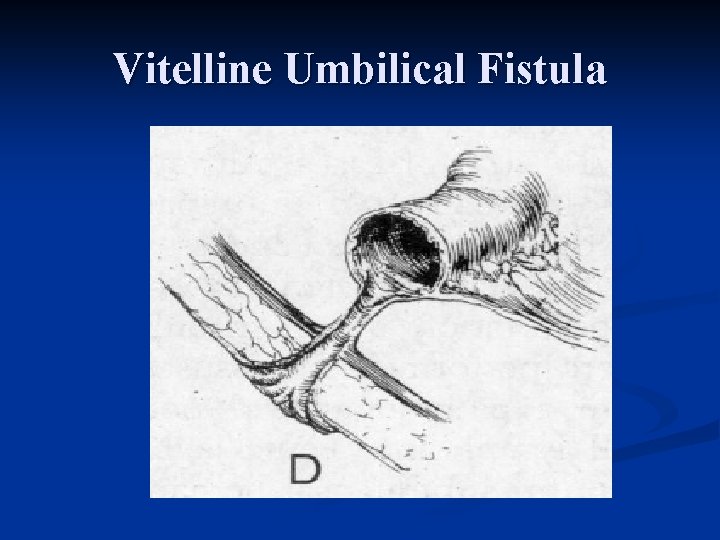 Vitelline Umbilical Fistula 