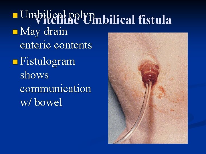 n Umbilical polyp Vitelline Umbilical fistula n May drain enteric contents n Fistulogram shows
