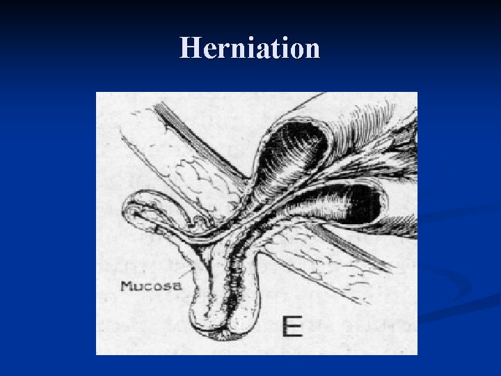 Herniation 