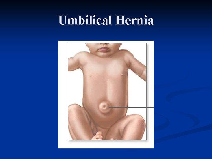 Umbilical Hernia 