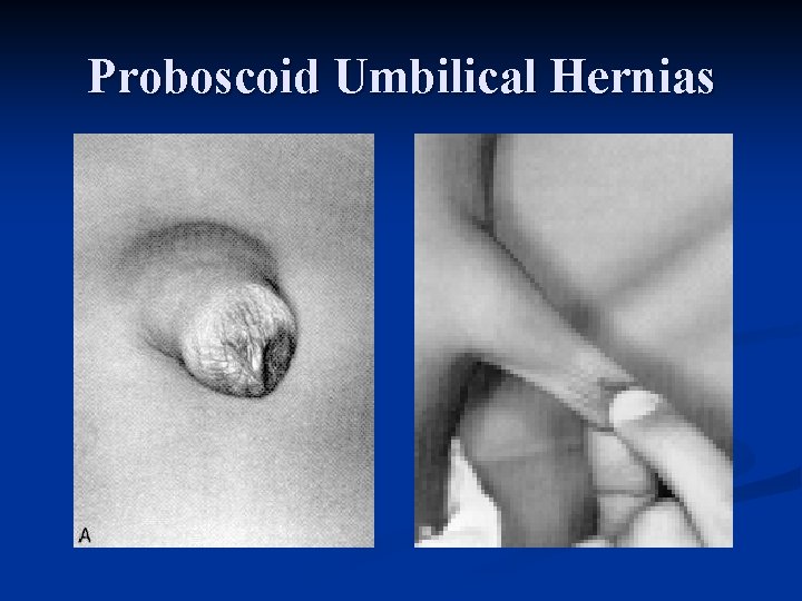 Proboscoid Umbilical Hernias 