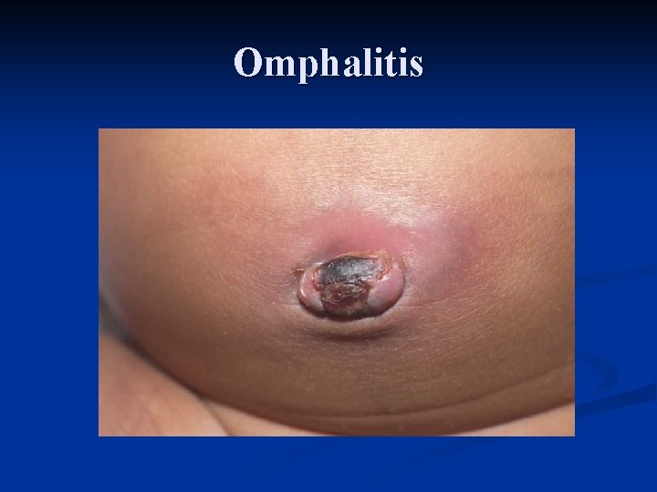 Omphalitis 