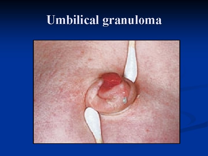 Umbilical granuloma 
