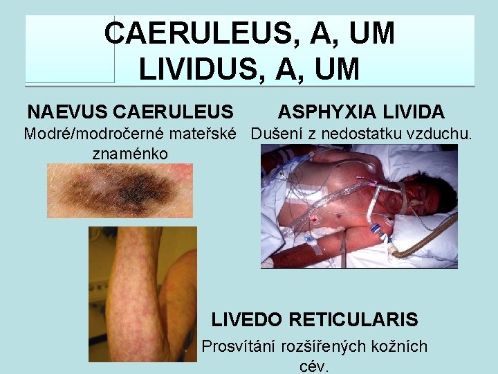 CAERULEUS, A, UM LIVIDUS, A, UM NAEVUS CAERULEUS ASPHYXIA LIVIDA Modré/modročerné mateřské Dušení z