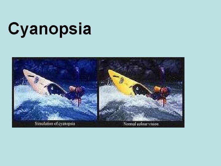 Cyanopsia 