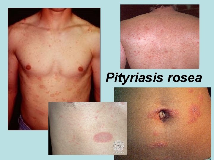 Pityriasis rosea 