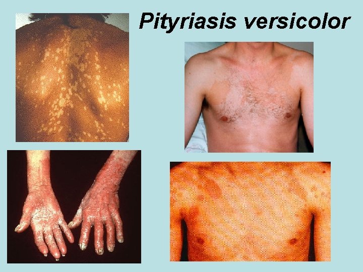 Pityriasis versicolor 