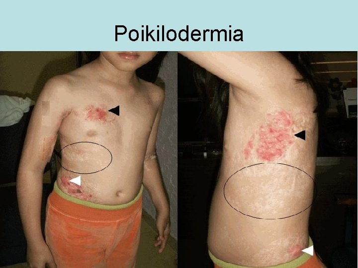 Poikilodermia 