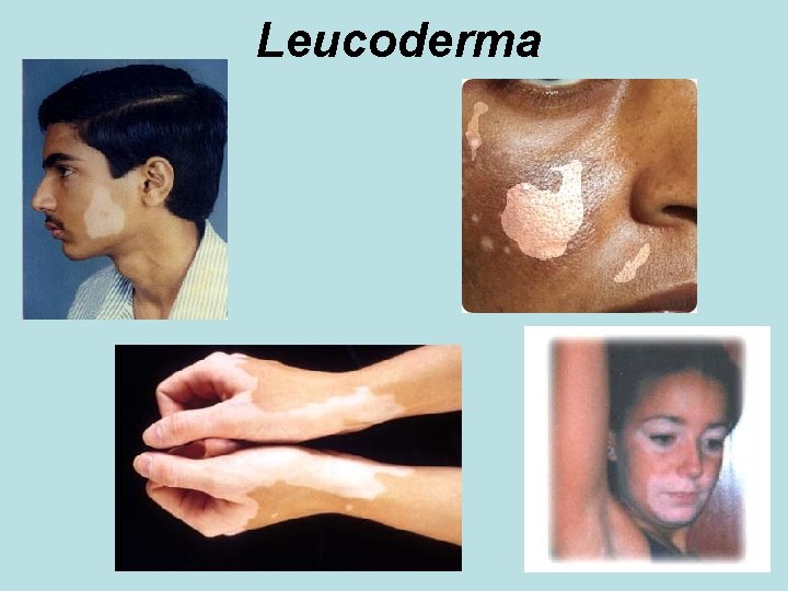 Leucoderma 