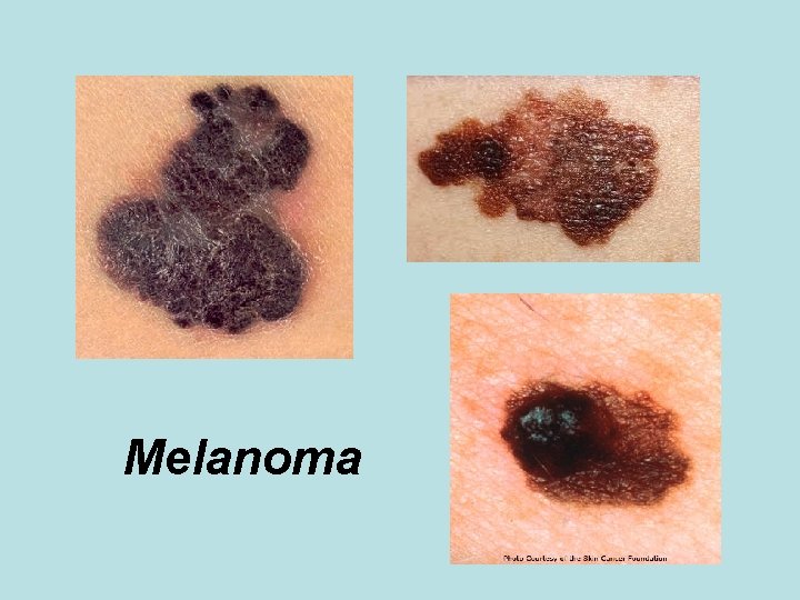 Melanoma 