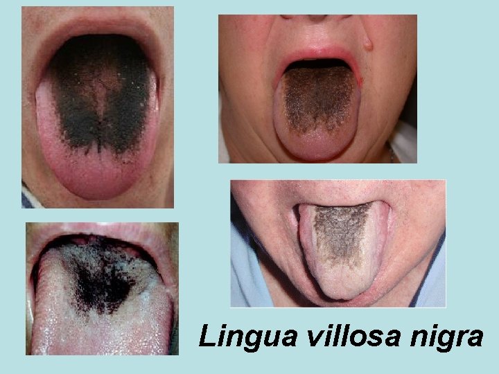 Lingua villosa nigra 