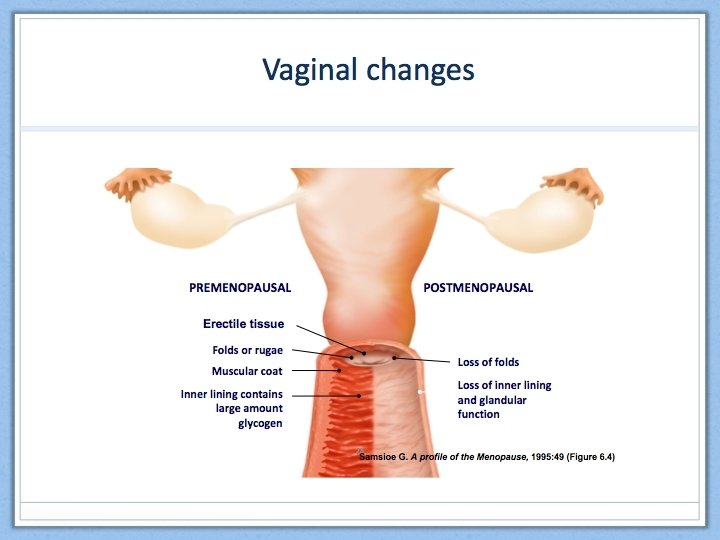 The Impact of the Menopause Medium Term – Urogenital effects Vaginal ● Dryness ●