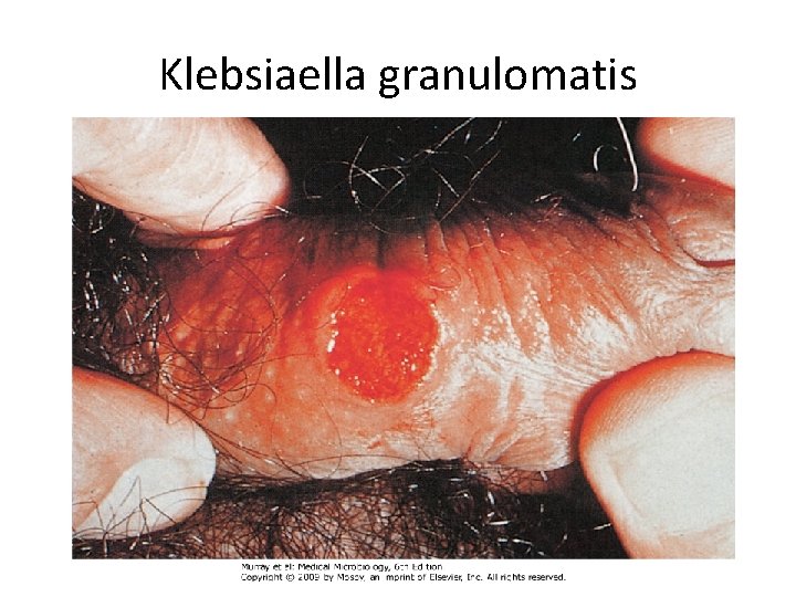 Klebsiaella granulomatis Klebsiaella granulomatis
