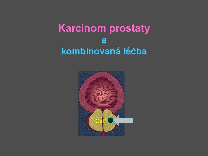 Karcinom prostaty a kombinovaná léčba Ca. P 
