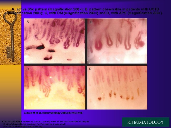 A, active SSc pattern (magnification 200×); B, pattern observable in patients with UCTD (magnification