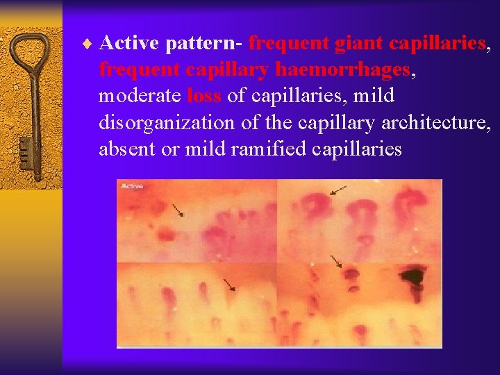 ¨ Active pattern- frequent giant capillaries, frequent capillary haemorrhages, moderate loss of capillaries, mild