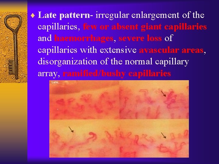 ¨ Late pattern- irregular enlargement of the capillaries, few or absent giant capillaries and