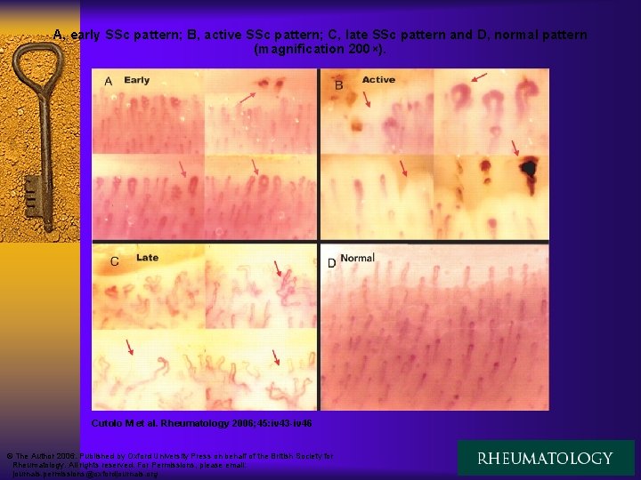 A, early SSc pattern; B, active SSc pattern; C, late SSc pattern and D,