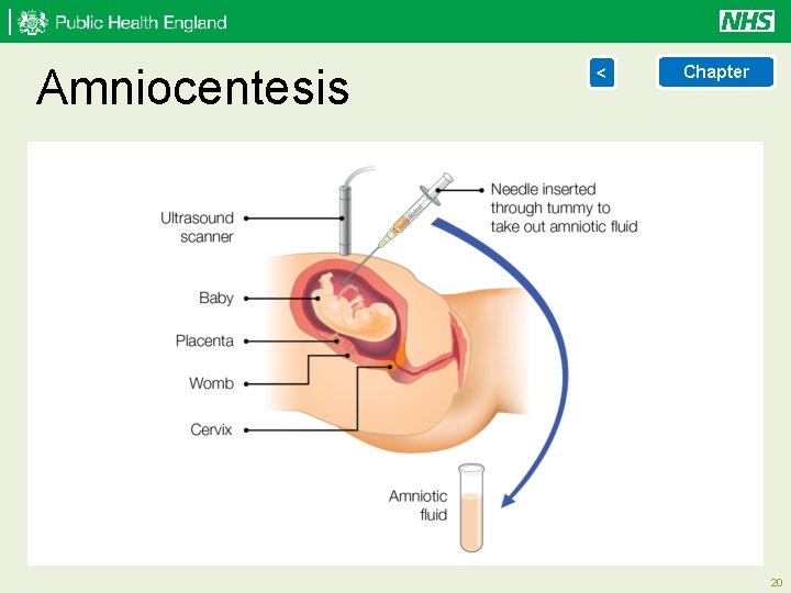 Amniocentesis < Chapter 20 