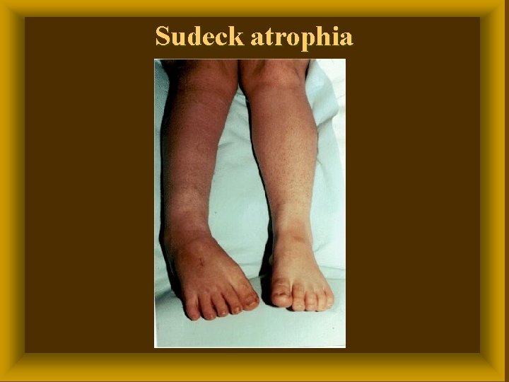 Sudeck atrophia 