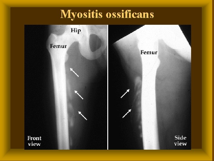 Myositis ossificans 