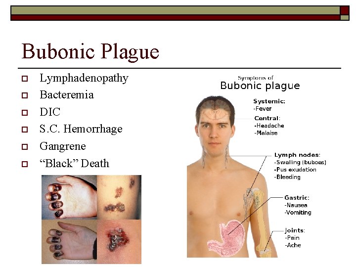 Bubonic Plague o o o Lymphadenopathy Bacteremia DIC S. C. Hemorrhage Gangrene “Black” Death