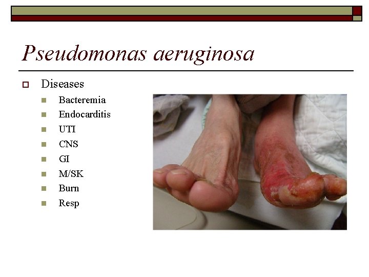 Pseudomonas aeruginosa o Diseases n n n n Bacteremia Endocarditis UTI CNS GI M/SK