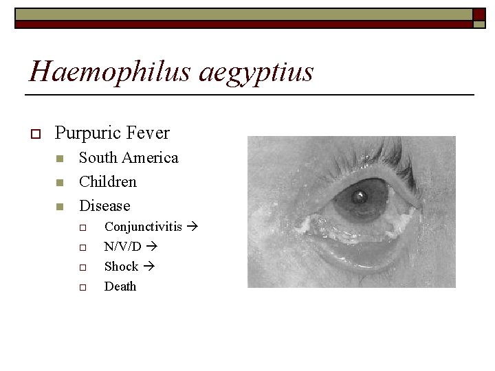 Haemophilus aegyptius o Purpuric Fever n n n South America Children Disease o o