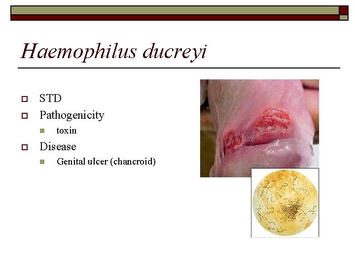 Haemophilus ducreyi o o STD Pathogenicity n o toxin Disease n Genital ulcer (chancroid)