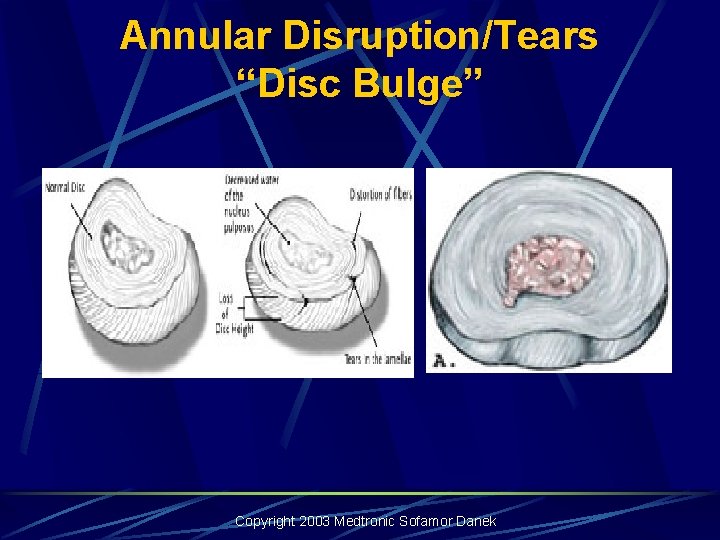 Annular Disruption/Tears “Disc Bulge” Copyright 2003 Medtronic Sofamor Danek Annular Disruption/Tears “Disc Bulge” Copyright 2003 Medtronic Sofamor Danek