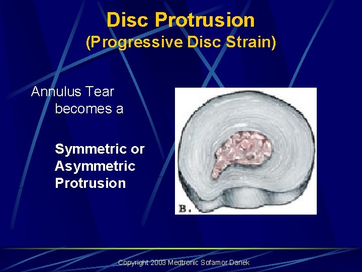 Disc Protrusion (Progressive Disc Strain) Annulus Tear becomes a Symmetric or Asymmetric Protrusion Copyright Disc Protrusion (Progressive Disc Strain) Annulus Tear becomes a Symmetric or Asymmetric Protrusion Copyright