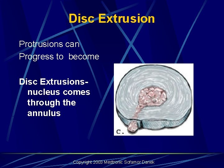 Disc Extrusion Protrusions can Progress to become Disc Extrusions- nucleus comes through the annulus Disc Extrusion Protrusions can Progress to become Disc Extrusions- nucleus comes through the annulus