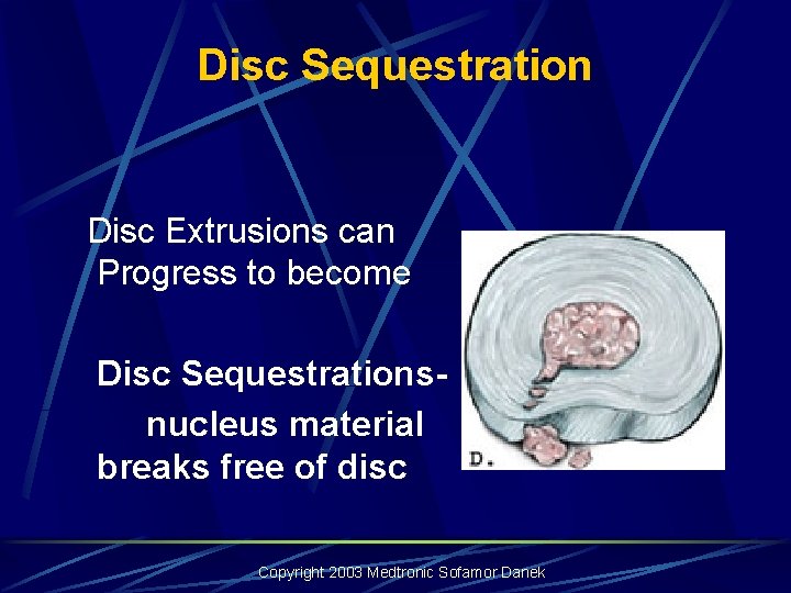 Disc Sequestration Disc Extrusions can Progress to become Disc Sequestrationsnucleus material breaks free of Disc Sequestration Disc Extrusions can Progress to become Disc Sequestrationsnucleus material breaks free of