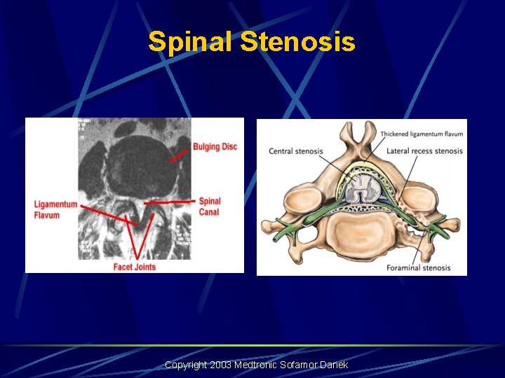 Spinal Stenosis Copyright 2003 Medtronic Sofamor Danek Spinal Stenosis Copyright 2003 Medtronic Sofamor Danek