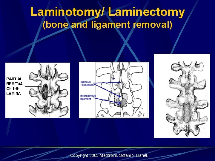 Laminotomy/ Laminectomy (bone and ligament removal) Copyright 2003 Medtronic Sofamor Danek Laminotomy/ Laminectomy (bone and ligament removal) Copyright 2003 Medtronic Sofamor Danek