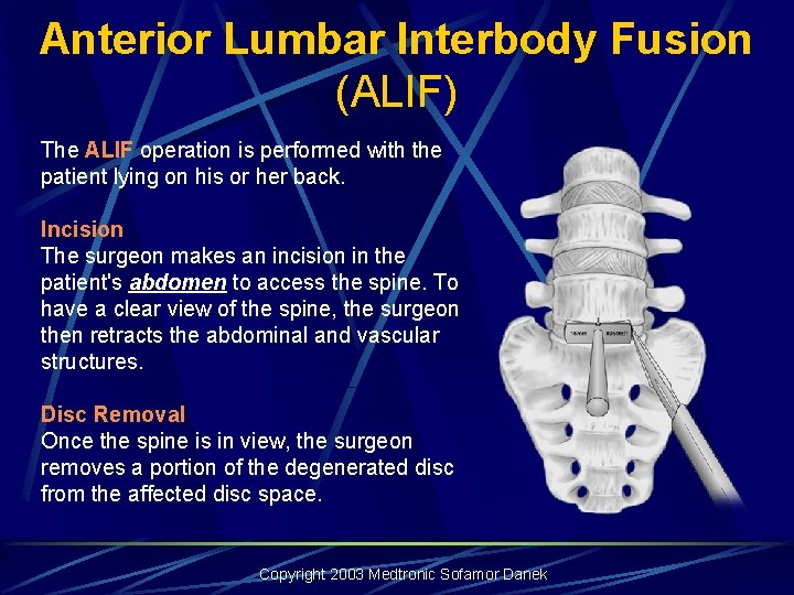 Anterior Lumbar Interbody Fusion (ALIF) The ALIF operation is performed with the patient lying Anterior Lumbar Interbody Fusion (ALIF) The ALIF operation is performed with the patient lying