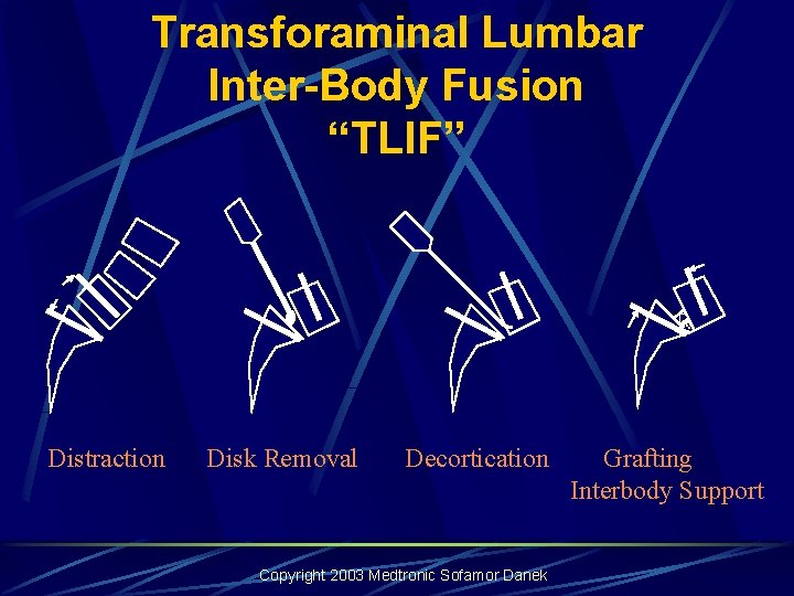 Transforaminal Lumbar Inter-Body Fusion “TLIF” Distraction Disk Removal Decortication Copyright 2003 Medtronic Sofamor Danek Transforaminal Lumbar Inter-Body Fusion “TLIF” Distraction Disk Removal Decortication Copyright 2003 Medtronic Sofamor Danek