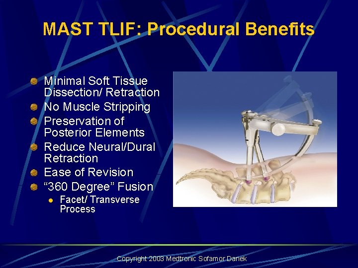 MAST TLIF: Procedural Benefits Minimal Soft Tissue Dissection/ Retraction No Muscle Stripping Preservation of MAST TLIF: Procedural Benefits Minimal Soft Tissue Dissection/ Retraction No Muscle Stripping Preservation of