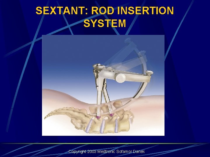 SEXTANT: ROD INSERTION SYSTEM Copyright 2003 Medtronic Sofamor Danek SEXTANT: ROD INSERTION SYSTEM Copyright 2003 Medtronic Sofamor Danek